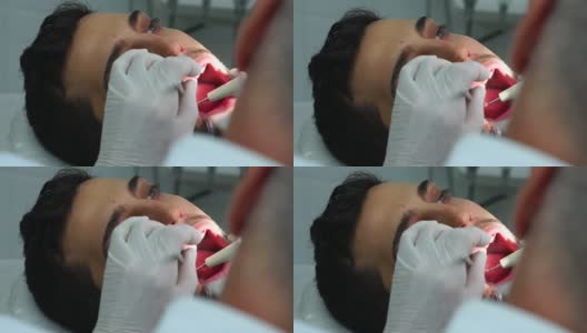 牙医在男人的牙齿上钻孔高清在线视频素材下载