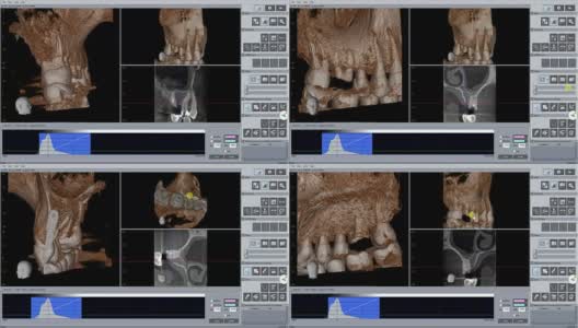 医生正在检查3D牙科扫描为未来种植高清在线视频素材下载