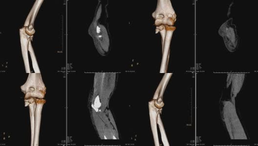 CT扫描仪右肘二维、三维图像渲染。高清在线视频素材下载