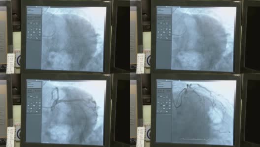 冠状动脉造影设备的筛选，移动心脏和血液高清在线视频素材下载