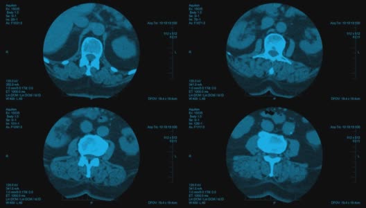 脊柱计算机断层扫描结果可视化。椎间盘筛检的水平切片高清在线视频素材下载