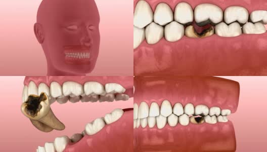失去臼齿。3D动画的人的牙齿和假牙的概念高清在线视频素材下载