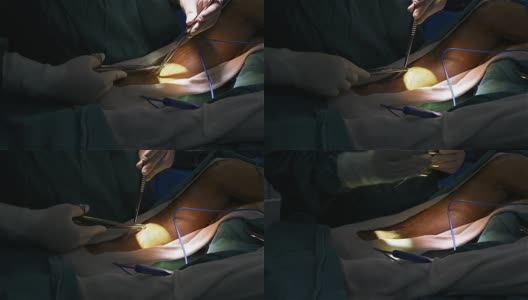 外科医生采集静脉用于冠状动脉旁路移植术高清在线视频素材下载