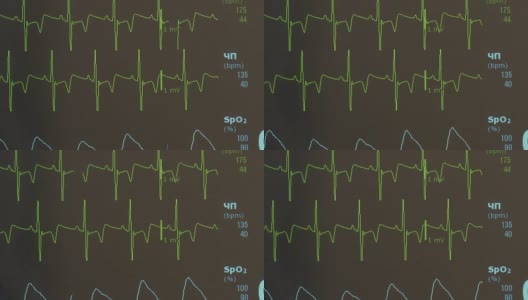 术中心律不齐的心电图和脉搏图像。高清在线视频素材下载