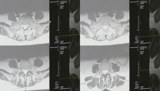 MRI上的脊髓和脊柱断层扫描。高清在线视频素材下载