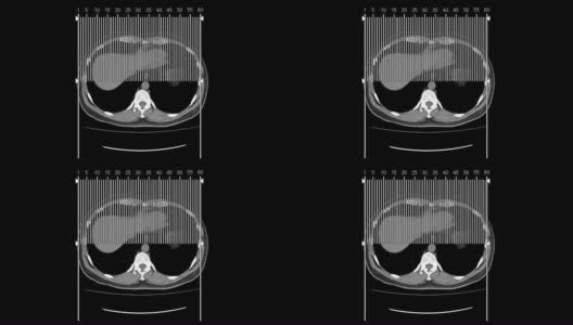 腹部侧面Ct扫描高清在线视频素材下载