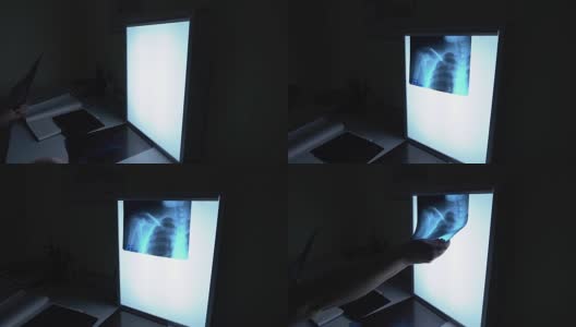 医生看了x光片。图像显示了锁骨、肋骨和肺。用骨内支架治疗骨折的过程。一个黑暗的房间高清在线视频素材下载
