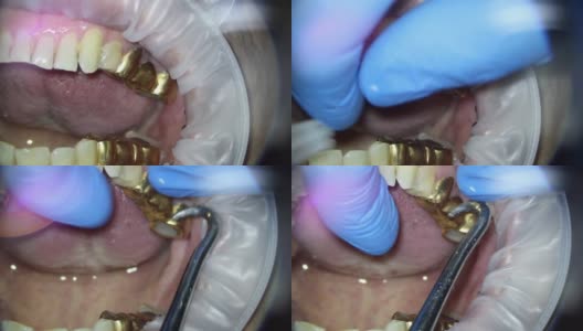 牙医。在显微镜下拍摄的视频。用钩子取下上颚的金桥高清在线视频素材下载