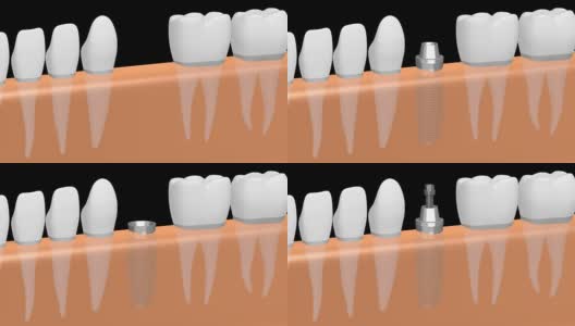 3D种植牙/种植牙高清在线视频素材下载