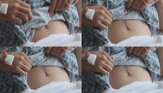 病人提起衬衫露出前列腺手术的疤痕高清在线视频素材下载