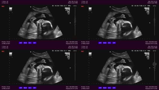 怀孕期间的体检筛查，超声波检查高清在线视频素材下载