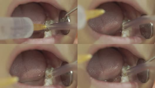 牙医将注射器轻轻注射到孩子的嘴里高清在线视频素材下载