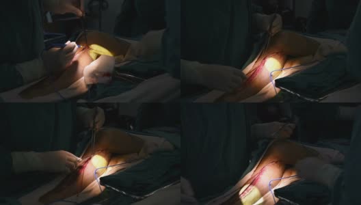 外科医生采集静脉用于冠状动脉旁路移植术高清在线视频素材下载