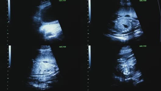 人体胚胎的医学超声扫描。在电脑显示器上，你可以看到24周的宝宝——8号腿高清在线视频素材下载