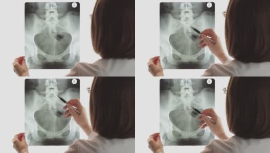 女医生带着眼镜手持和检查盆腔骨，在屏幕背景下扫描。放射科医生指出x光片上的问题区域高清在线视频素材下载