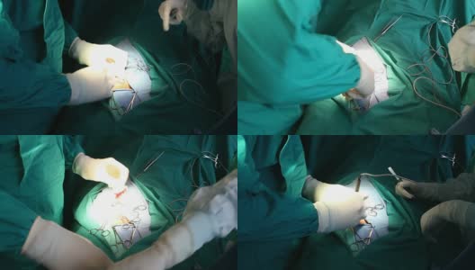 HD:腹股沟疝手术(3)高清在线视频素材下载