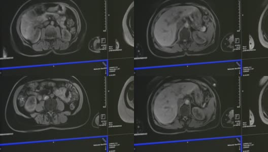 MRI脑部断层扫描。高清在线视频素材下载