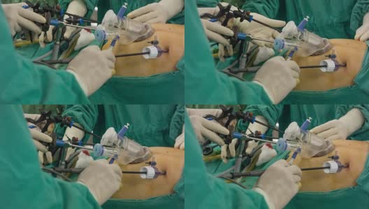 HD DOLLY : Endoscopic surgery高清在线视频素材下载
