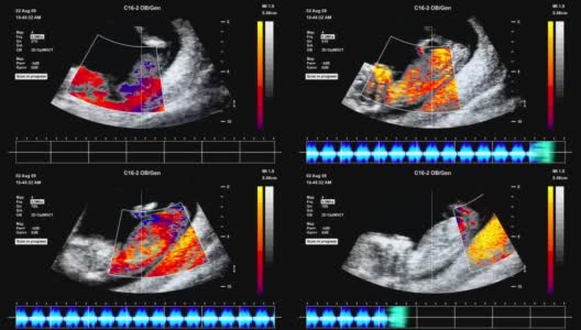 胎儿超声扫描高清在线视频素材下载