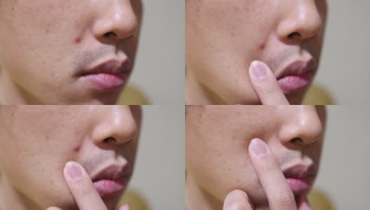 一个日本男人脸上的粉刺高清在线视频素材下载