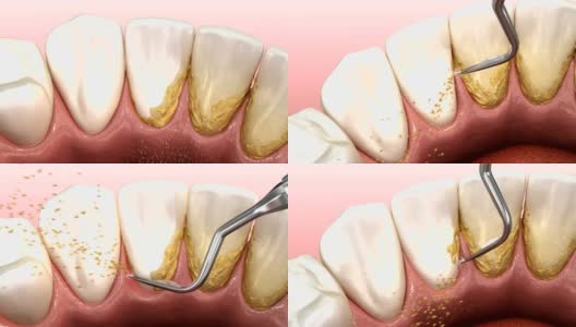 口腔卫生:超声波洁牙机，清除牙石和牙菌斑。医学上精确的人类牙齿治疗3D动画高清在线视频素材下载
