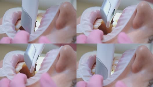 牙科诊所正畸医生用口腔内扫描仪扫描病人的牙齿。高清在线视频素材下载