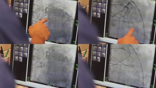 医生在电脑屏幕上看静脉高清在线视频素材下载