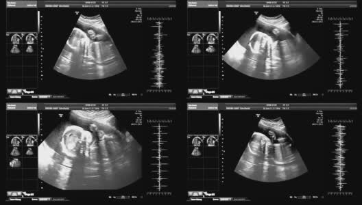 HD -医疗超声扫描。婴儿轮廓高清在线视频素材下载