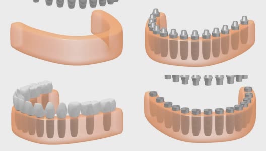 3D牙科种植/牙齿种植高清在线视频素材下载