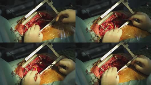 心脏的外科操作高清在线视频素材下载