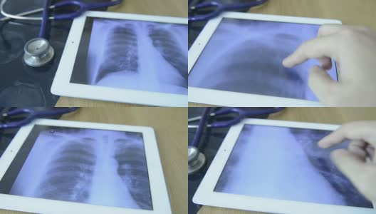 医生在平板电脑上检查x射线图像高清在线视频素材下载