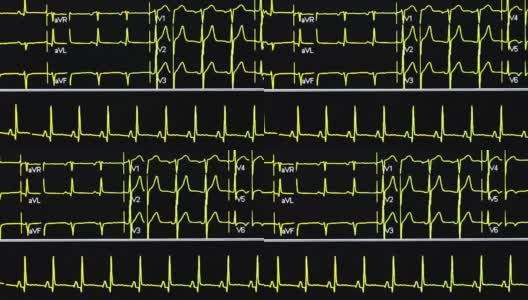 心电图高清在线视频素材下载