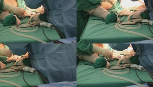 抽脂手术仪器高清在线视频素材下载