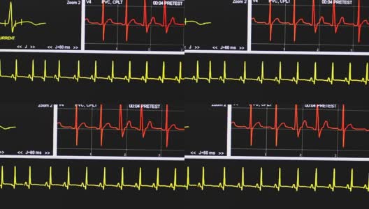 心电图高清在线视频素材下载