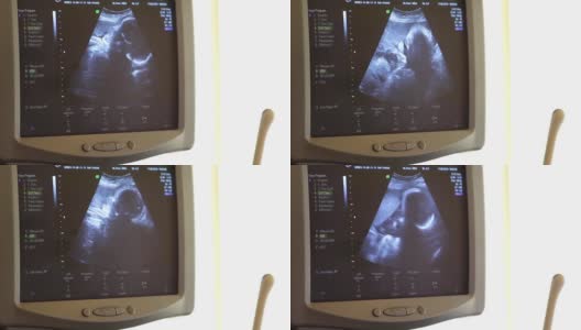 人体胚胎的医学超声扫描。24周婴儿的心脏高清在线视频素材下载