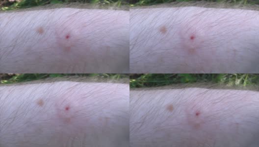 蜜蜂蜇了养蜂人的手。特写镜头，伤口发炎的部位。高清在线视频素材下载