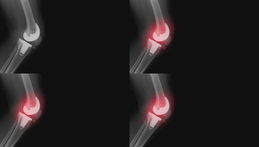 全膝关节置换术x线照片高清在线视频素材下载