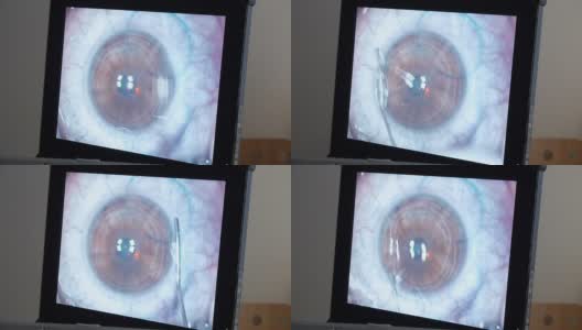 MACRO:激光眼科手术，第6步高清在线视频素材下载