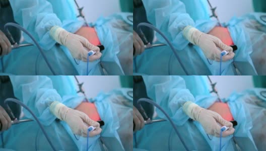 腹腔镜手术一个人腹腔内的腹腔镜手术高清在线视频素材下载