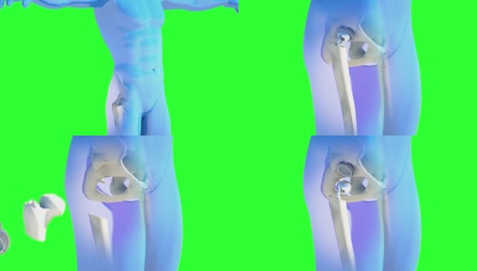 髋关节置换植入物安装在骨盆骨。医学精准3D动画高清在线视频素材下载