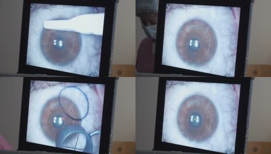 MACRO:激光眼科手术，第1步高清在线视频素材下载