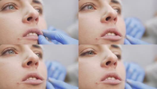 用肉毒杆菌增加嘴唇的美容程序高清在线视频素材下载