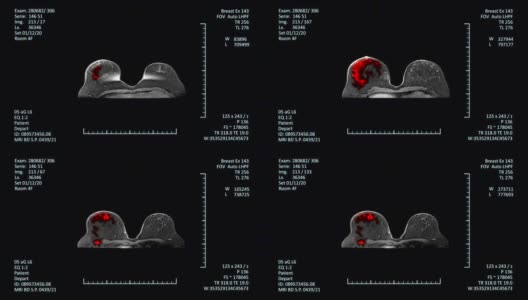 MRI扫描监测乳腺癌检测高清在线视频素材下载