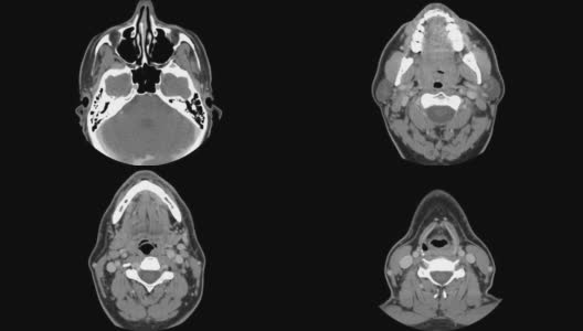 轴向CT头部扫描高清在线视频素材下载