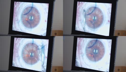 MACRO:激光眼科手术，第4步高清在线视频素材下载